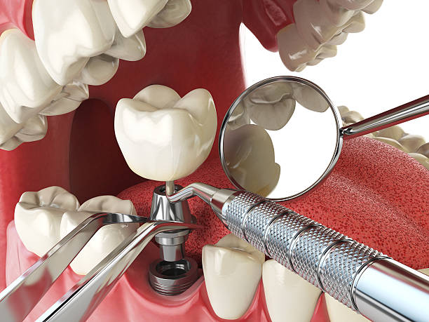 Best Emergency Tooth Extraction in Lukachukai, AZ